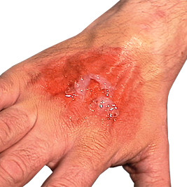 Luka Akibat Bahan Kimia